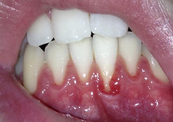 Betroffener Zahn :( - (Gesundheit, Medizin, Arzt)