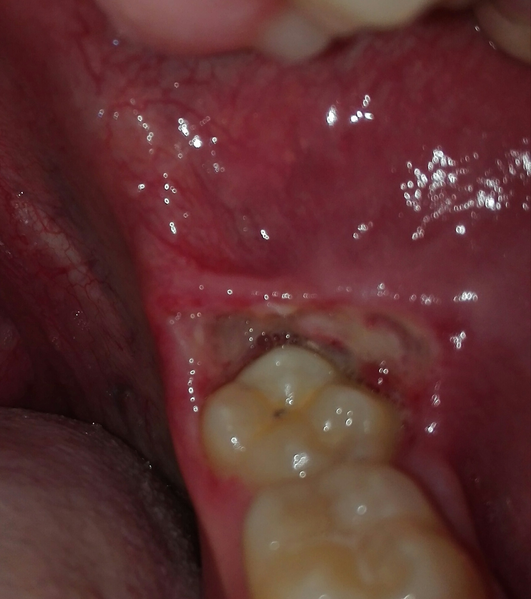 Zahnfleisch aufgeschnitten heilungsdauer? (Zähne, Weisheitszahn, entzündet)
