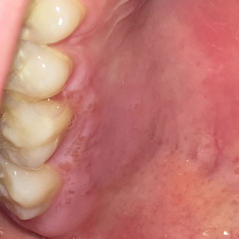 Die Bläschen befindet sich rechts neben den Zähnen  - (Zähne, Mund, Zahnfleisch)