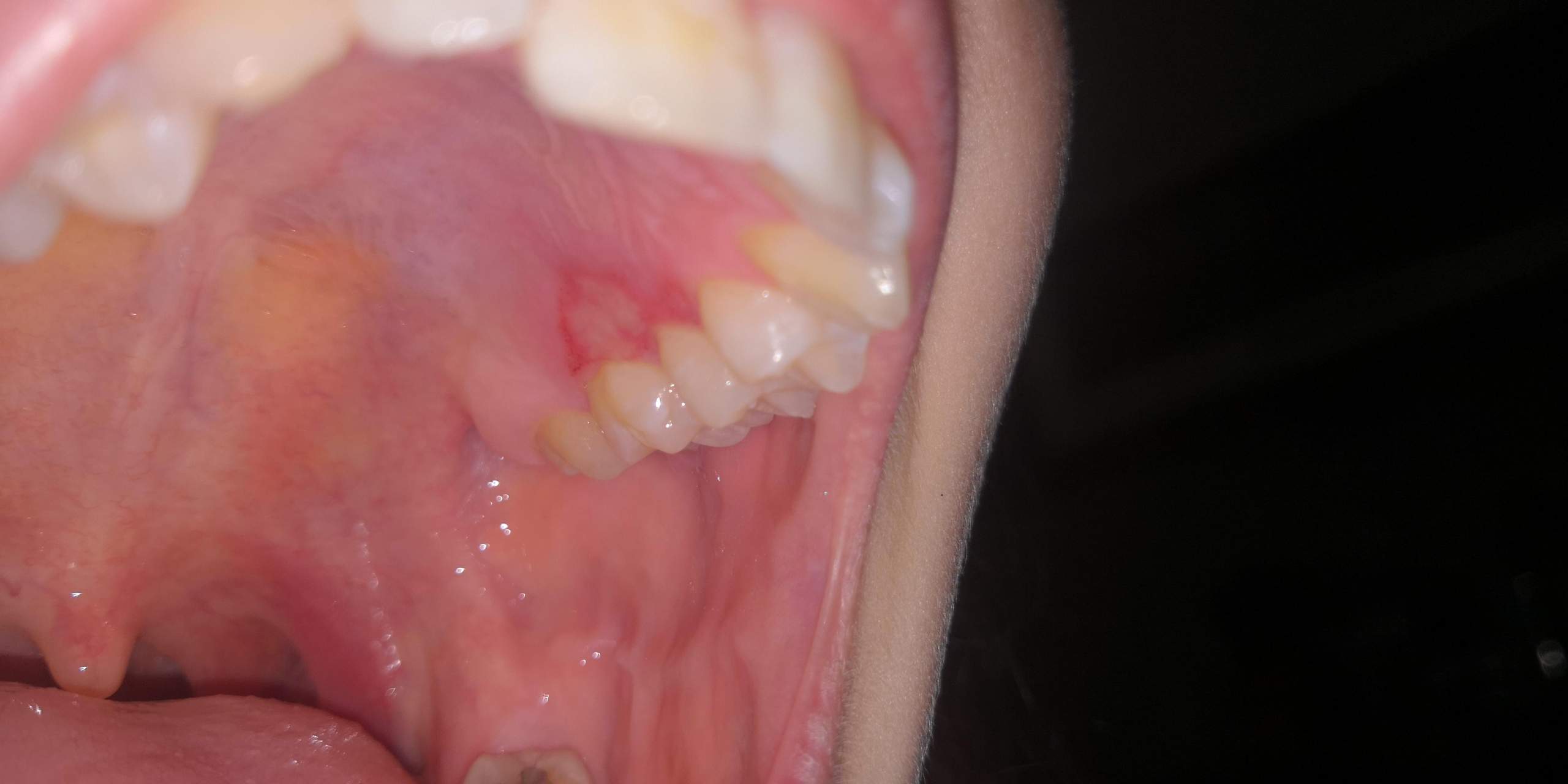 Zahnfleisch entzündet beim Backenzahn? (Zähne, Entzündung)