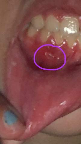 Zahnfleisch Entzündung?