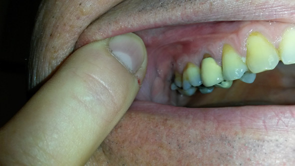 Zahnfleisch - (Zähne, Zahnfleischentzündung)