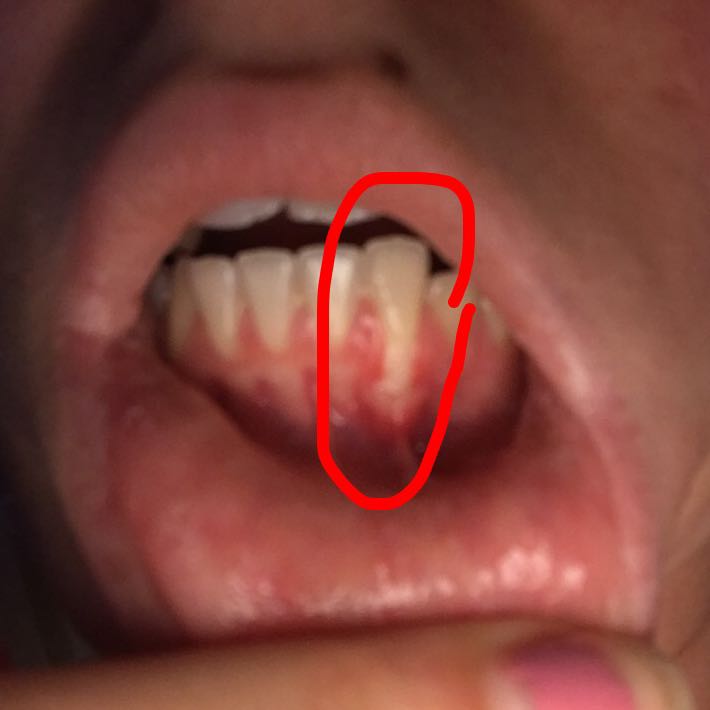 Zahnfleisch Geht Runter Gesundheit Und Medizin Gesundheit Zahne Zahnfleisch Geht Runter Gesundheit Und Medizin Gesundheit Zahne