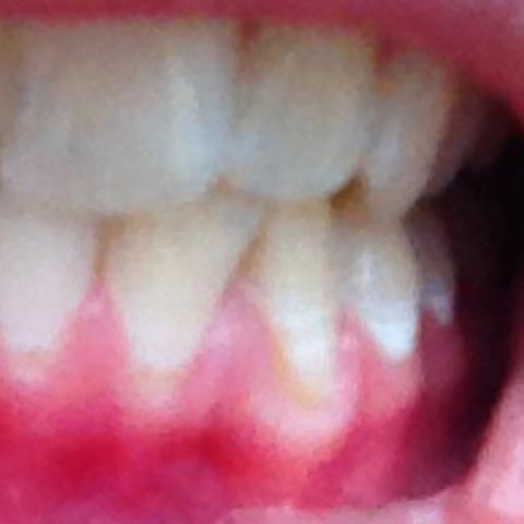 Zahnfleisch geht zurück an den unteren Zähnen  - (Zähne, Zahnarzt, Behandlung)