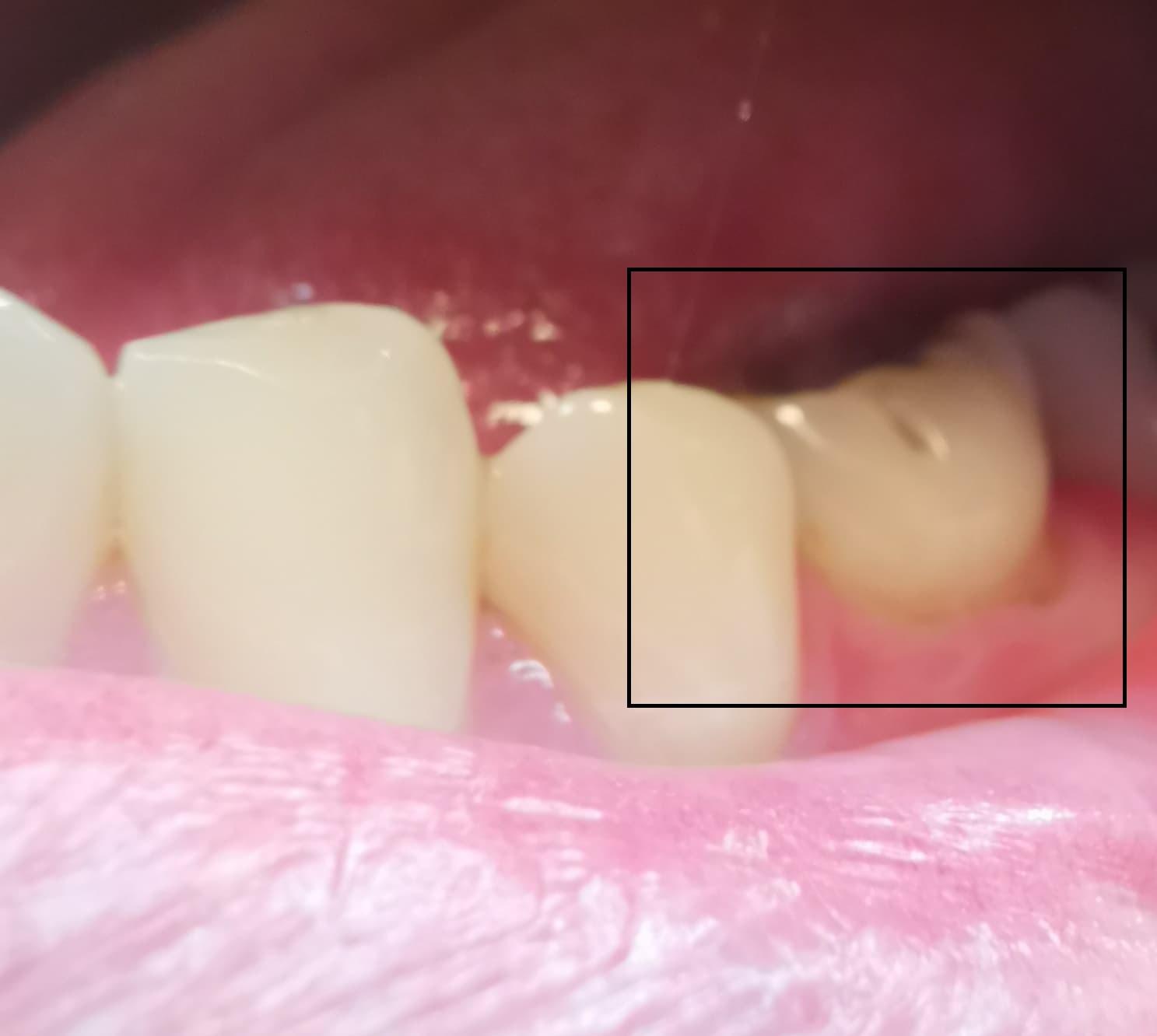 Zahnfleisch Hat Sich An Einen Zahn Leicht Zuruck Gebildet Gesundheit Und Medizin Zahnpflege