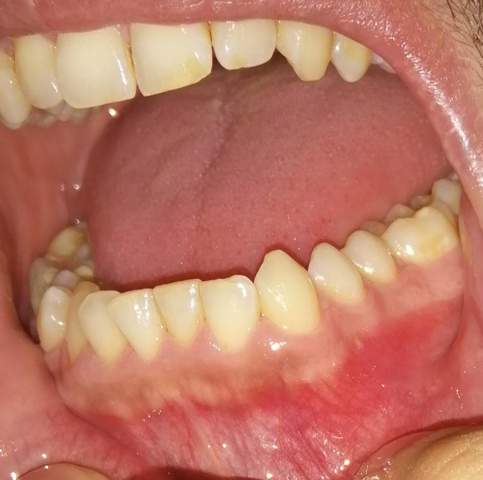 Zahnfleisch unten immer rot  normal dunkle Stellen?