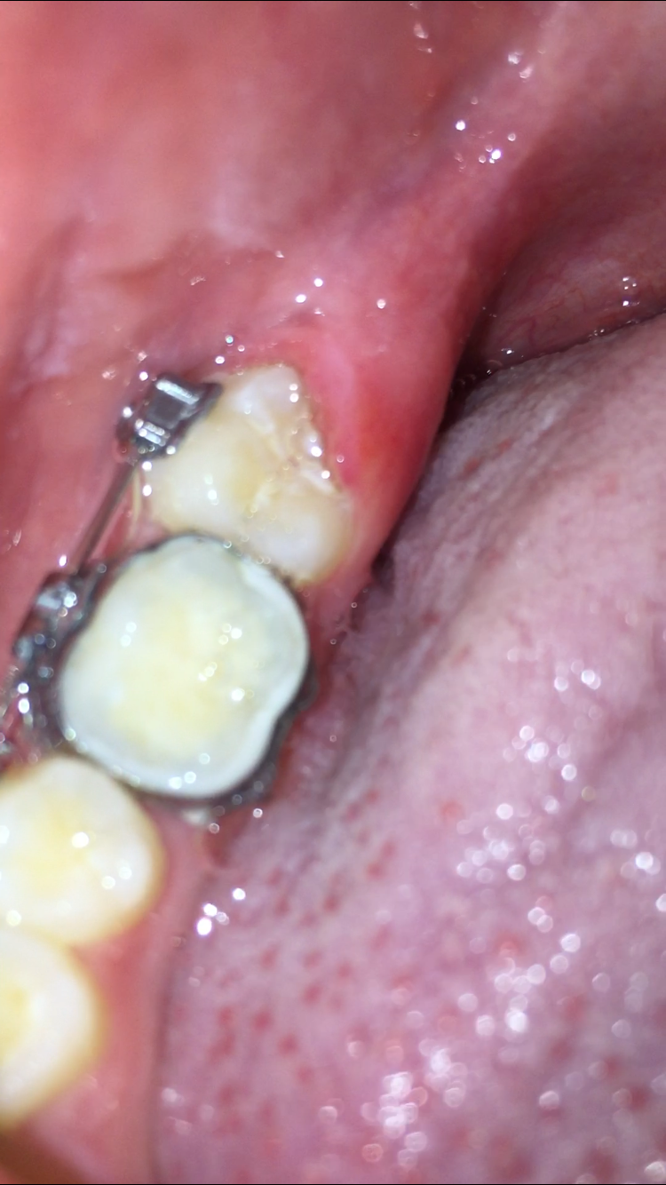 Zahnfleisch wächst über Backenzahn? (Gesundheit und Medizin, Zähne, Zahnfleischentzündung)