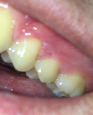 Zahnfleisch weißer Punkt.   Was ist das  - (Gesundheit und Medizin, Zähne, Zahnfleisch)