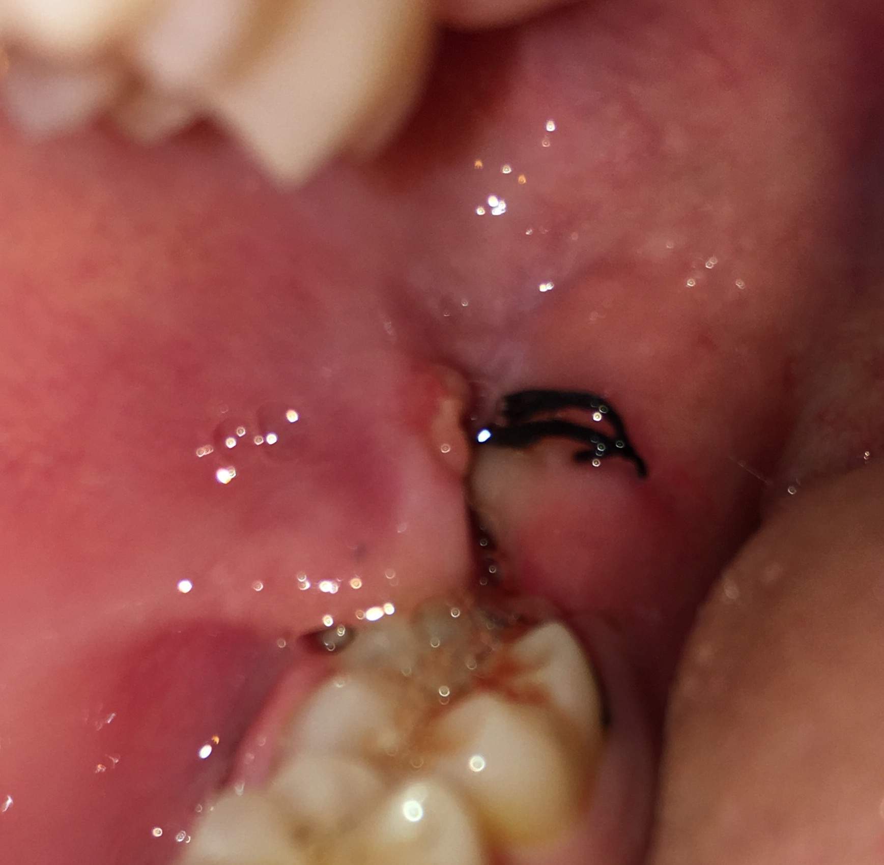 Zahnfleisch Wucherung nach Weisheitszah OP. Ist das normal? (Medizin, Zahnarzt, Weisheitszähne)