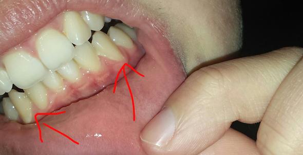 Zahnfleisch zurückgegangen  - (Zähne, Zahnfleisch)