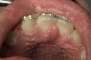 Zahnfleischentzündung?