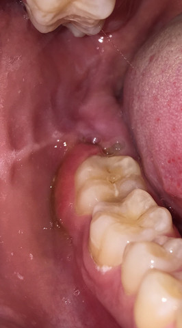 Zahnfleischentzundung Was Kann Ich Tun Gesundheit Und Medizin Zahnmedizin Zahnschmerzen Zahnfleischentzundung Was Kann Ich Tun Gesundheit Und Medizin Zahnmedizin Zahnschmerzen