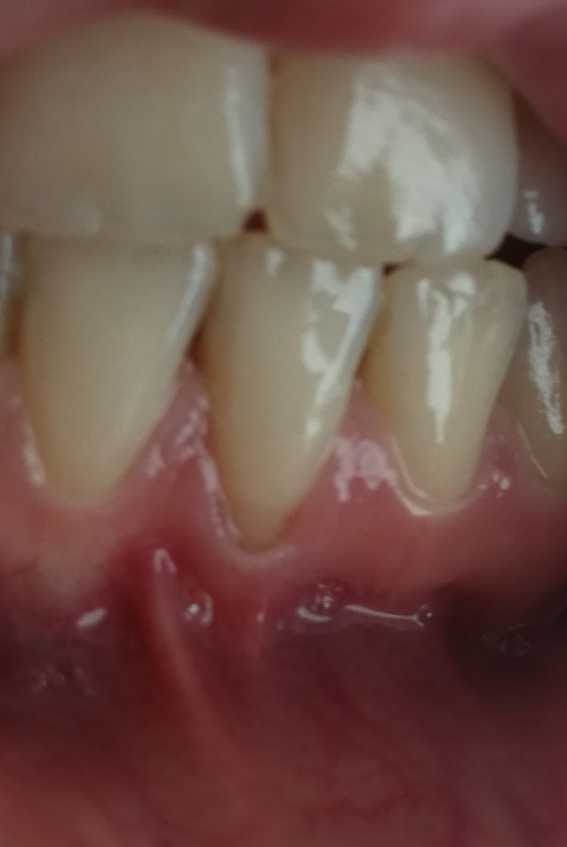 Zahnfleischrückgang Hilfe? (Gesundheit, Medizin, Arzt)