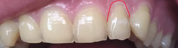 Bild zu meinen Zähnen - (Gesundheit, Zähne, Zahnarzt)