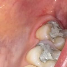 Zahnfüllung - (Arzt, Schmerzen, Zähne)