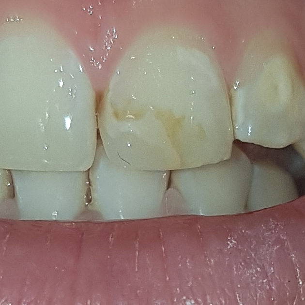 Zahnfullung Verfarbt Zahnarzt