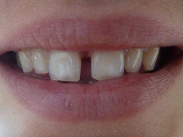 Zahnlücke bei den scheidezähnen entfernen?