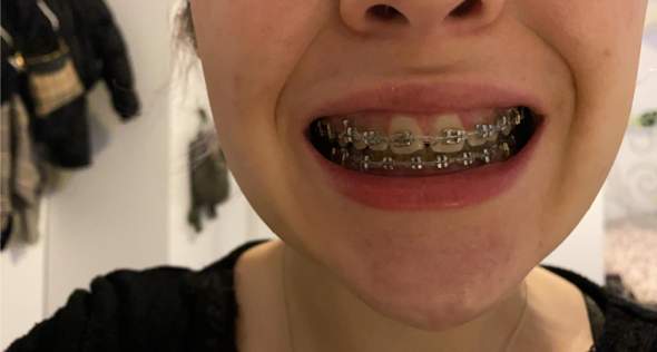 Zahnlücke kann sich wegen zu viel Zahnfleisch nicht schließen?