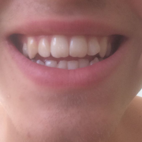 Wie man sieht ist es sehr klein, aber davor waren meine Zähne immer ganz zusamm. - (Männer, Arzt, Zähne)