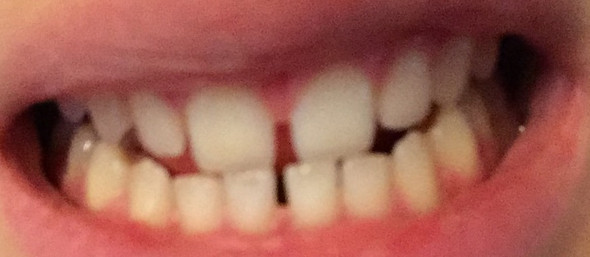 Grosse zahnlücke zwischen den schneidezähnen