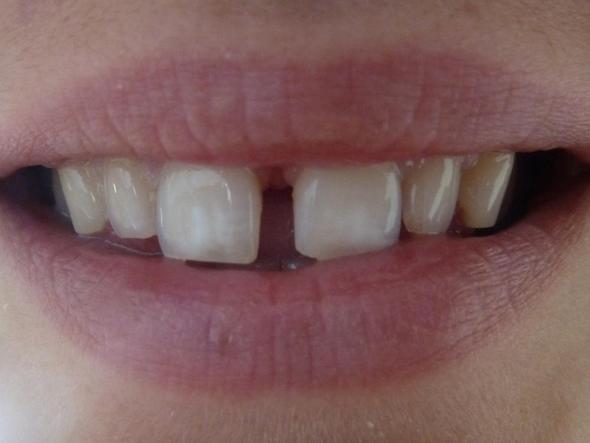 Zahnlücke - (Zähne, Zahnspange, Zahnlücke)