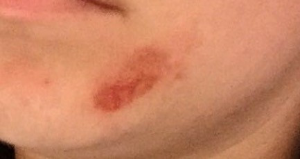 Zahnpasta Im Gesicht Und Haut Verbrannt Veratzt Beauty Pickel