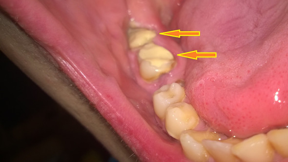 Die betroffenen Zähne - (Zahnarzt, Zahnmedizin, Zahnfleischentzündung)