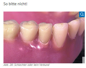 Zahnprothese Nicht Zufriedenstellend Zahne Krankenkasse Arztbesuch Zahnprothese Nicht Zufriedenstellend Zahne Krankenkasse Arztbesuch