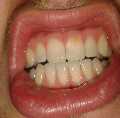 Bild 1 - (gelbe Zähne, Zahnschmelz)