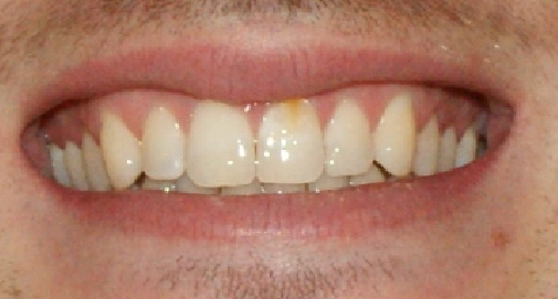 Bild 2 - (gelbe Zähne, Zahnschmelz)