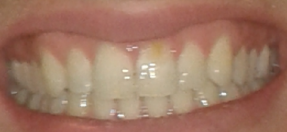 Bild 3 - (gelbe Zähne, Zahnschmelz)