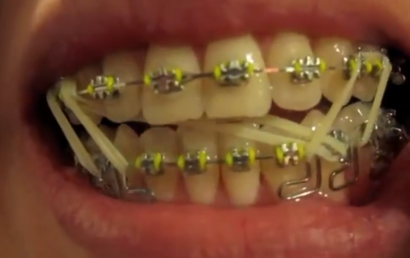 die gummies - (Gesundheit, Zähne, Zahnspange)