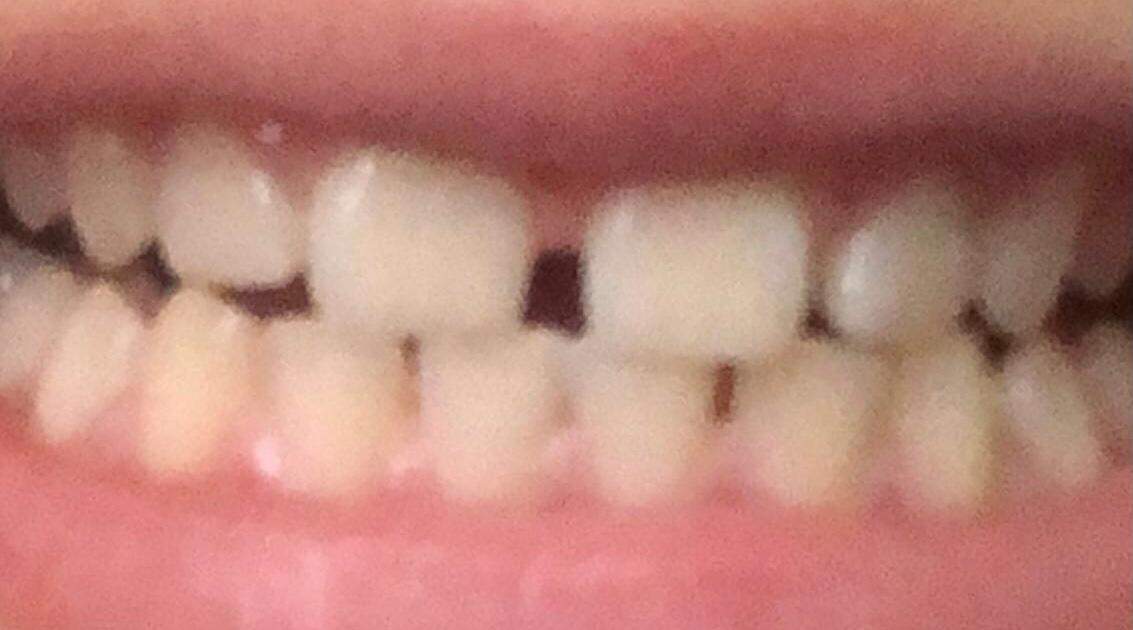 Ich Will Eine Zahnspange Brauche Aber Keine Zahnspange? (Kieferorthopäde)