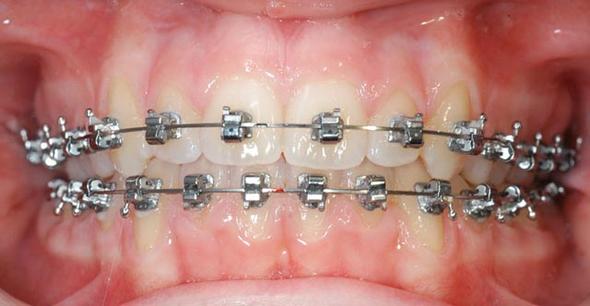 Wie lange dauert Behandlung mit Zahnspange?
