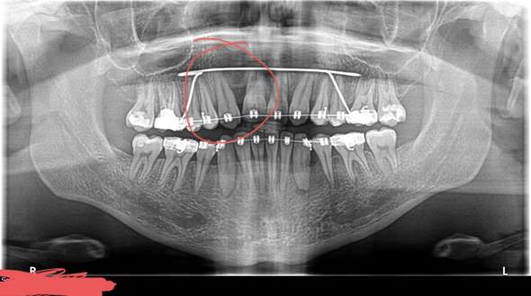 Zahnspange, gezogener Zahn, Knochenabbau?