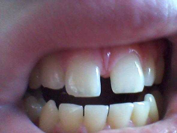 Hier ein BIld von der Zanhluecke - (Zahnspange)