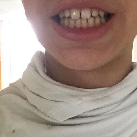 Das sind übrigens meine Zähne;)
 - (Zähne, Zahnspange, Karies)