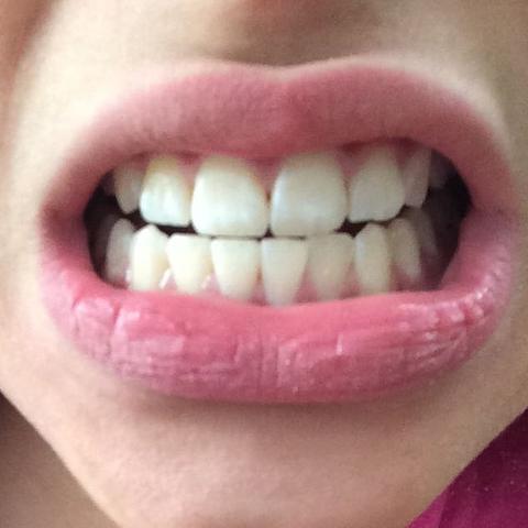 Meine Zähne 😁 - (Gebiss)