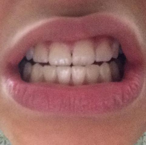Meine Zähne :( - (Zähne, Zahnspange, Kieferorthopäde)