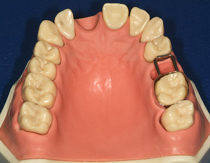 So was und noch der draht um den inneren zahnbogen - (Zahnspange, Ring)