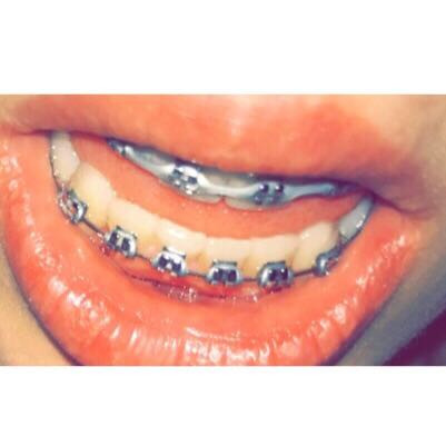 Zahnspange Sind Meine Zahne Gerade Gebiss