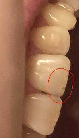 Zahnstück abgebrochen? (Zähne, Zahnmedizin, Karies)