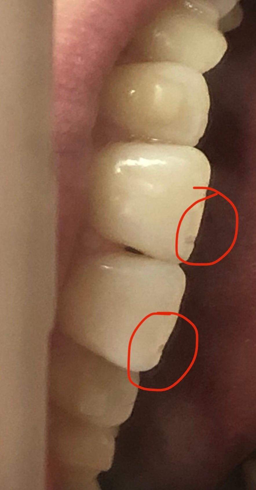 Zahnstück abgebrochen? (Zähne, Zahnmedizin, Karies)
