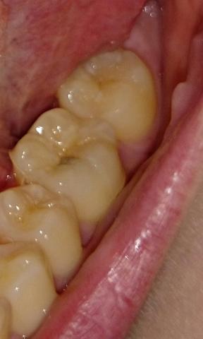 Zahn - (Zähne, Zahnverfärbungen)