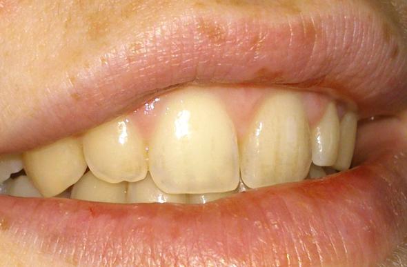 Zahnverfarbungen Was Tun Zahne Gelb Verfarbt Zahnverfarbungen Was Tun Zahne Gelb Verfarbt