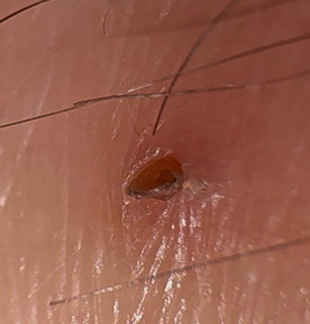 Zecke auf haut (mit bild)? (Medizin, Krankheit, Stich)