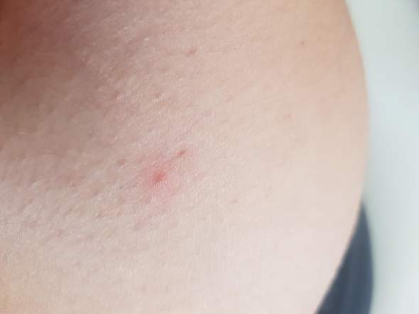 Zecke Beim Duschen Weggekratzt Gesundheit Und Medizin Zecke Beim Duschen Weggekratzt Gesundheit Und Medizin