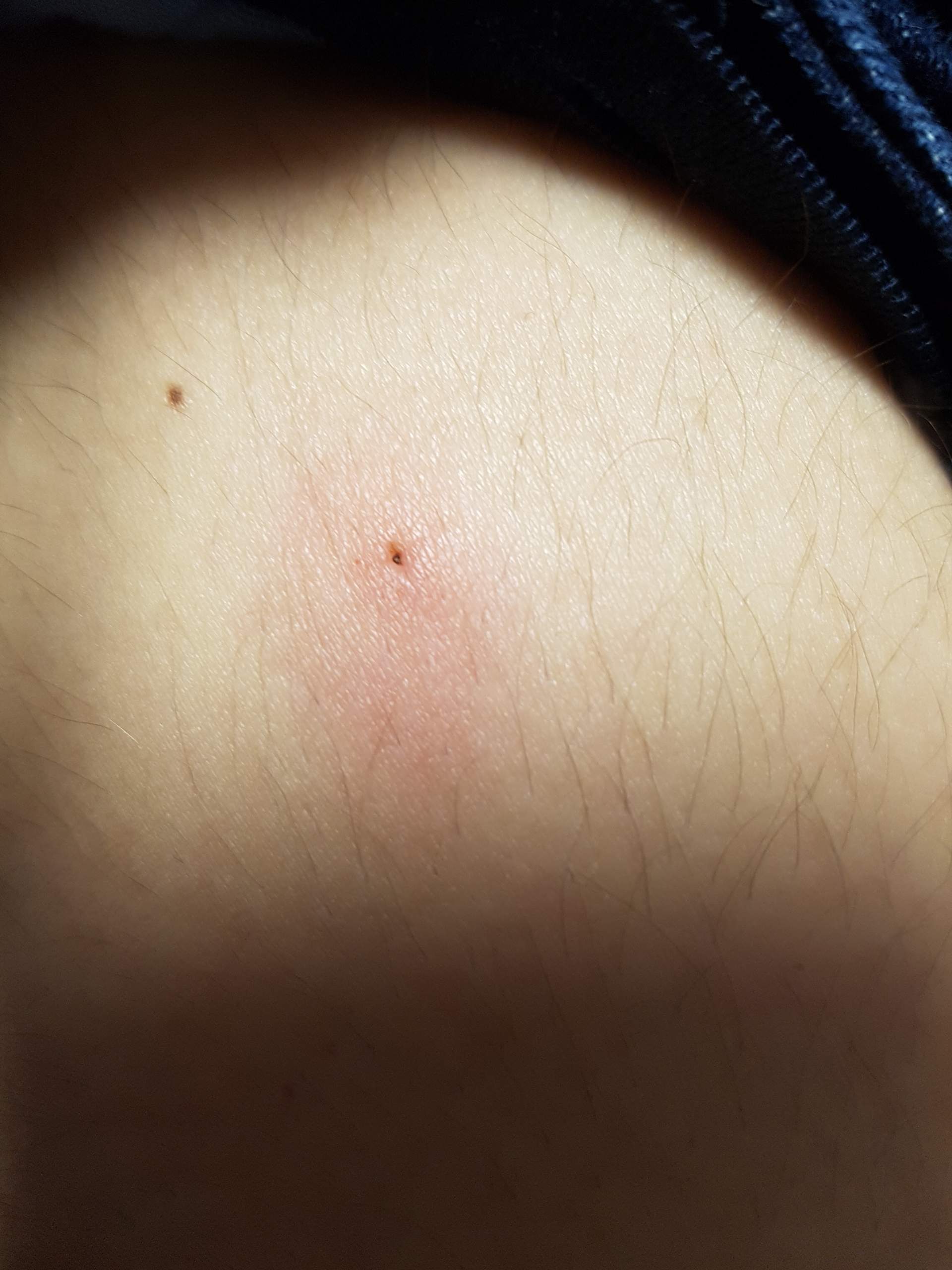 Zecken Kopf Ist Drinne Geblieben Zecke Zeckenbiss Zecken Kopf Ist Drinne Geblieben Zecke Zeckenbiss