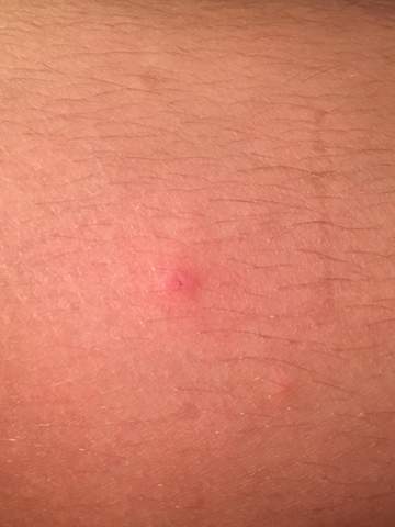 Zeckenbiss Rot Zeckenbiss Rot