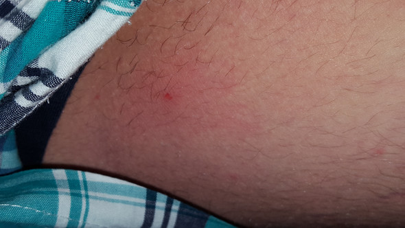 Zeckenbiss Habe Ich Sie Richtig Entfernt Zecke Borreliose